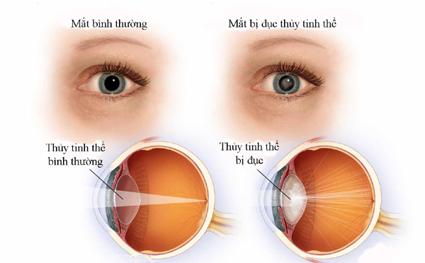 Những rối loạn của thể thủy tinh - Hình ảnh minh họa